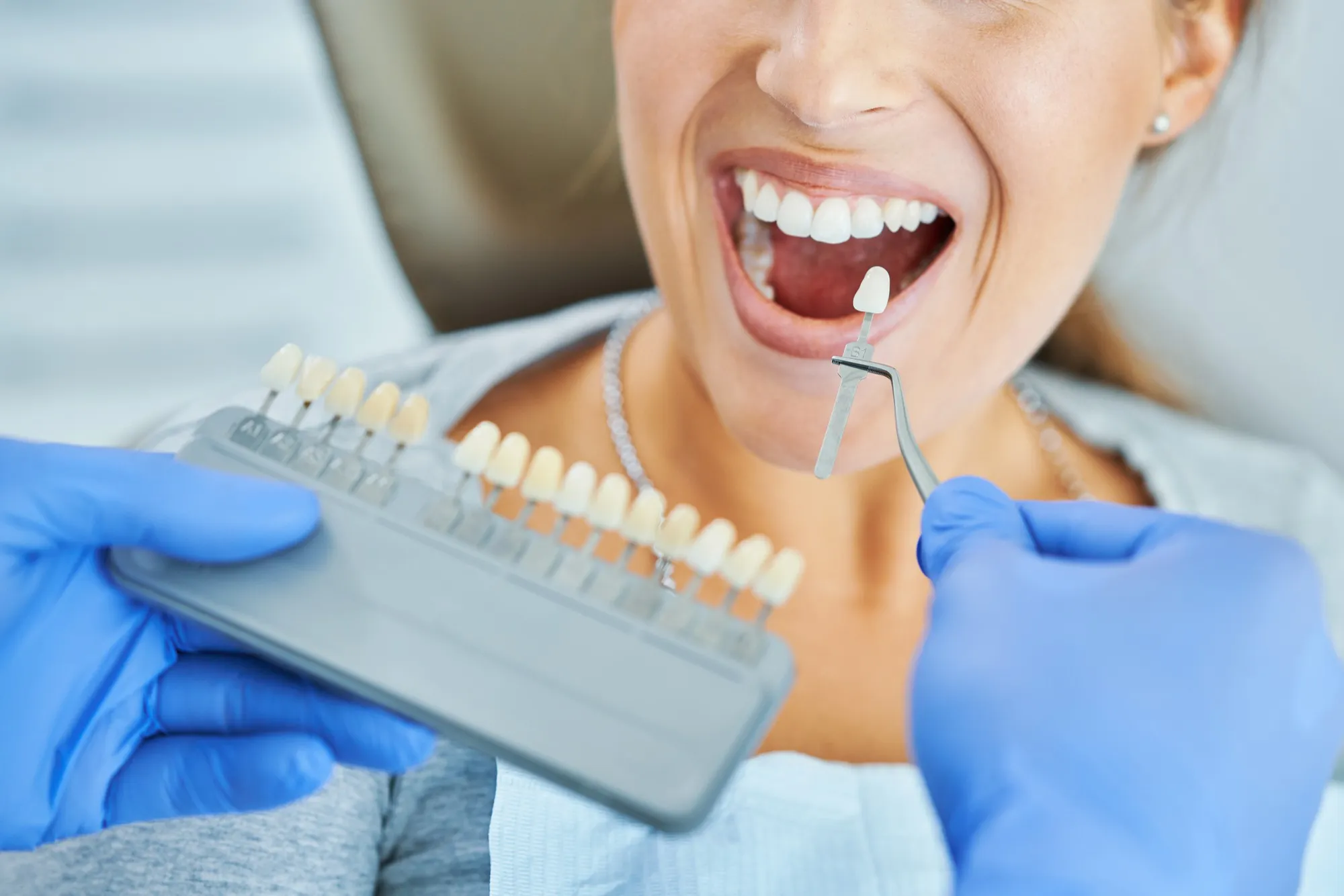carillas dentales clinica dental Arai